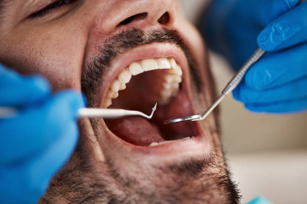 Best Emergency Wisdom Teeth Removal in North Kensington, MD